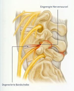 Einengung eines Nervenkanals der Lendenwirbelsäule